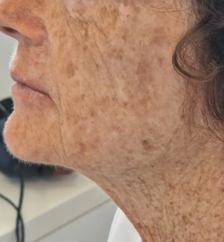 Profil gauche de la même patiente après une injection d’acide hyaluronique dans la joue