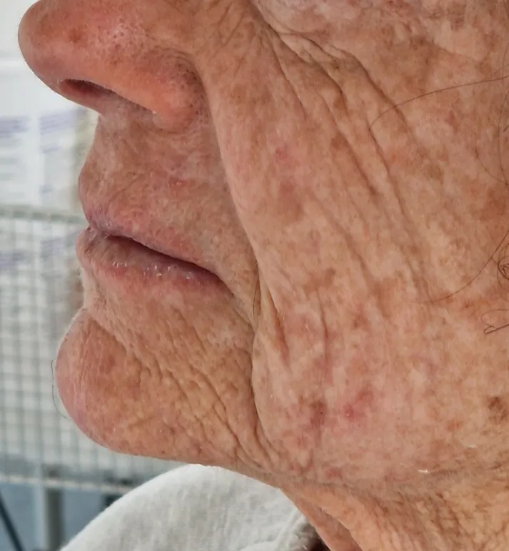 Profil gauche d’une patiente avant une injection d’acide hyaluronique dans la joue