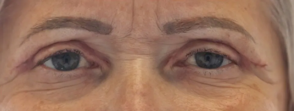 Yeux de la même patiente huit jours après une chirurgie des paupières