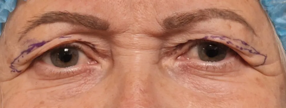 Yeux d’une patiente avant une chirurgie des paupières, avec les tracés de repérage de l’incision